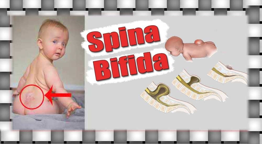 Spina Bifida Nedir, Hastalığın Belirtileri, Nedenleri ve Tipleri Nelerdir