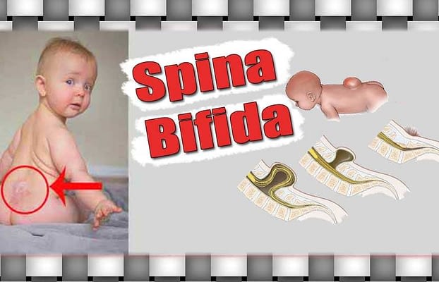 Spina Bifida Nedir, Hastalığın Belirtileri, Nedenleri ve Tipleri Nelerdir